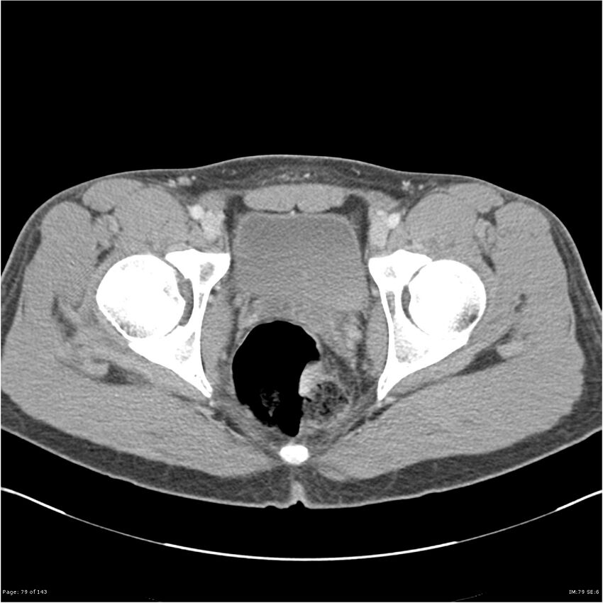 Acute appendicitis (Radiopaedia 25364-25615 B 69).jpg