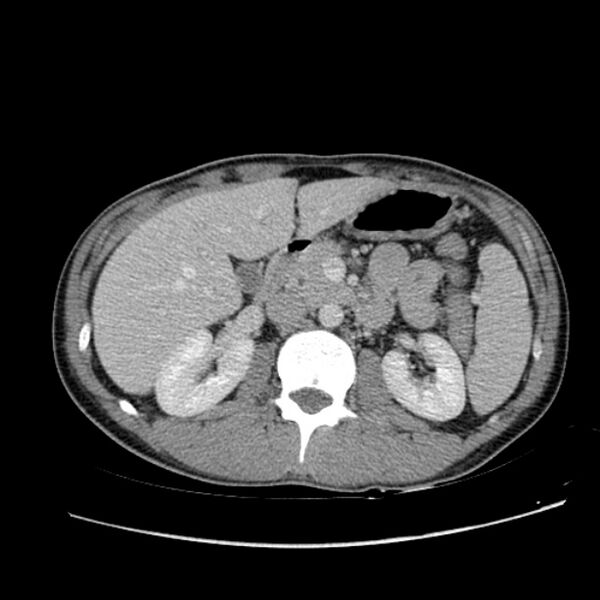 File:Acute appendicitis (Radiopaedia 27049-27227 Axial C+ portal venous phase 26).jpg