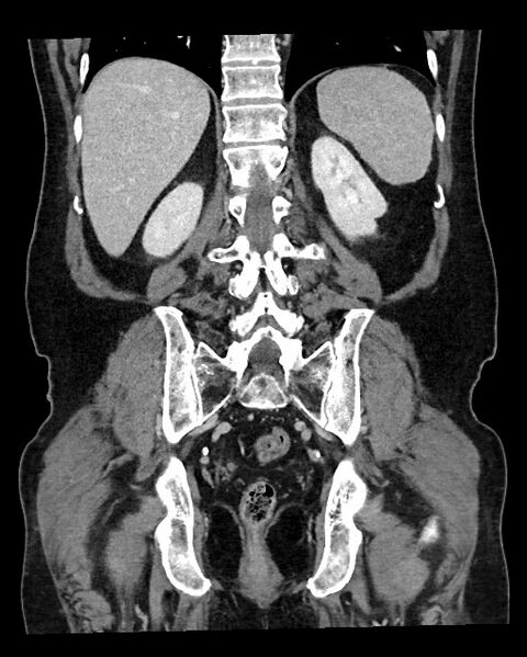File:Acute appendicitis - large appendicoliths (Radiopaedia 61805-69820 Coronal C+ portal venous phase 98).jpg
