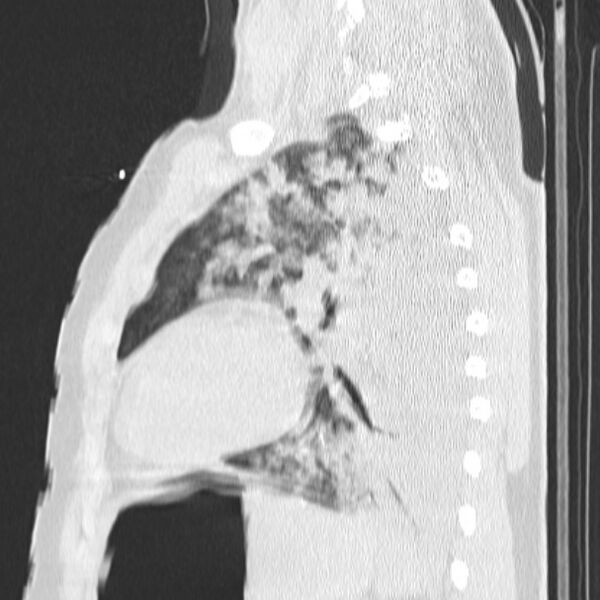 File:Acute aspiration pneumonitis (Radiopaedia 33605-34703 Sagittal lung window 59).jpg