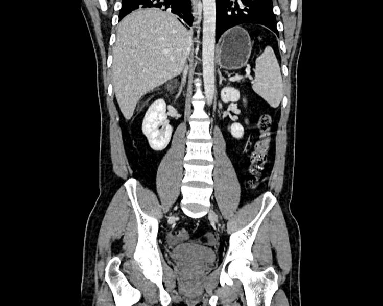File:Acute cholecystitis (Radiopaedia 53216-59182 Coronal C+ portal venous phase 12).jpg