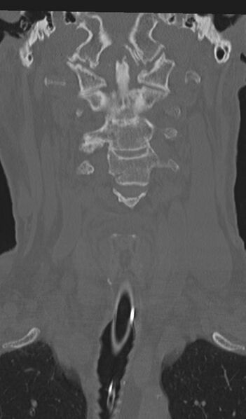 File:Acute on chronic subdural hematoma and thoracic vertebral injury in a multitrauma patient (Radiopaedia 31698-32619 Coronal bone window 17).jpg