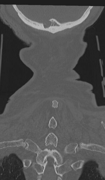 File:Acute on chronic subdural hematoma and thoracic vertebral injury in a multitrauma patient (Radiopaedia 31698-32619 Coronal bone window 64).jpg