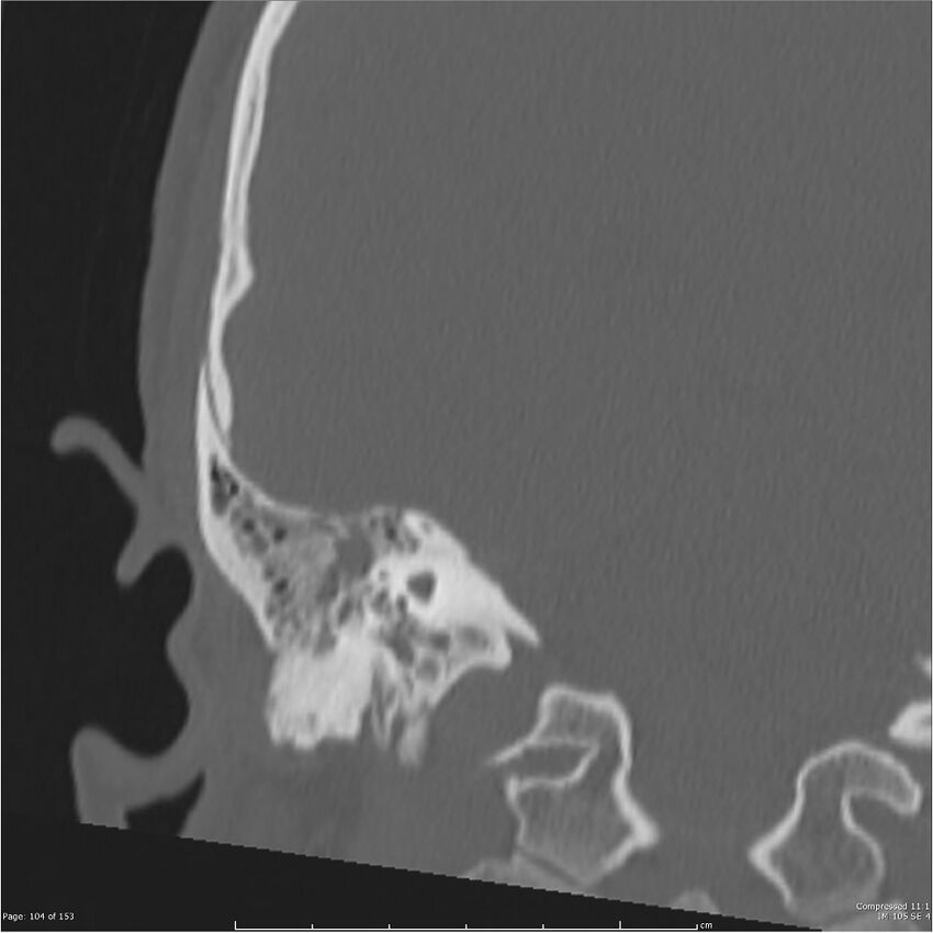 Acute otomastoiditis (Radiopaedia 28276-28512 Coronal PTB bone window reformat 35).jpg