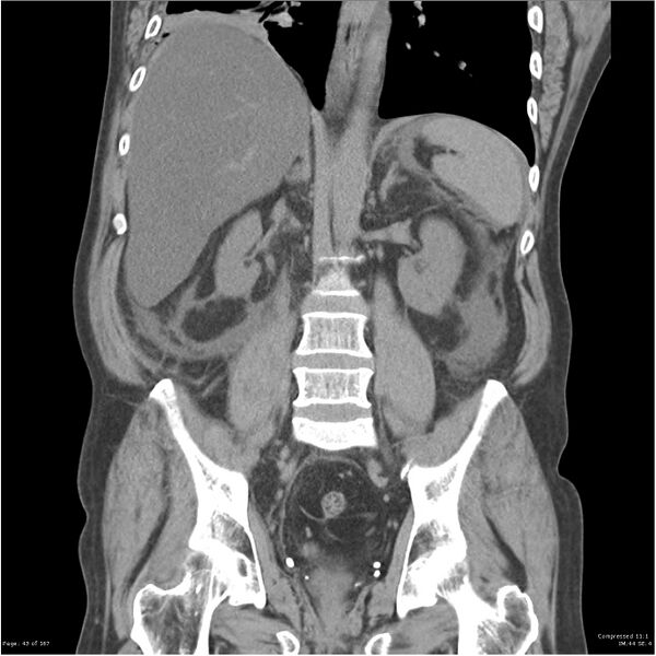 File:Acute pancreatitis (Radiopaedia 19135-19116 Coronal non-contrast 29).jpg
