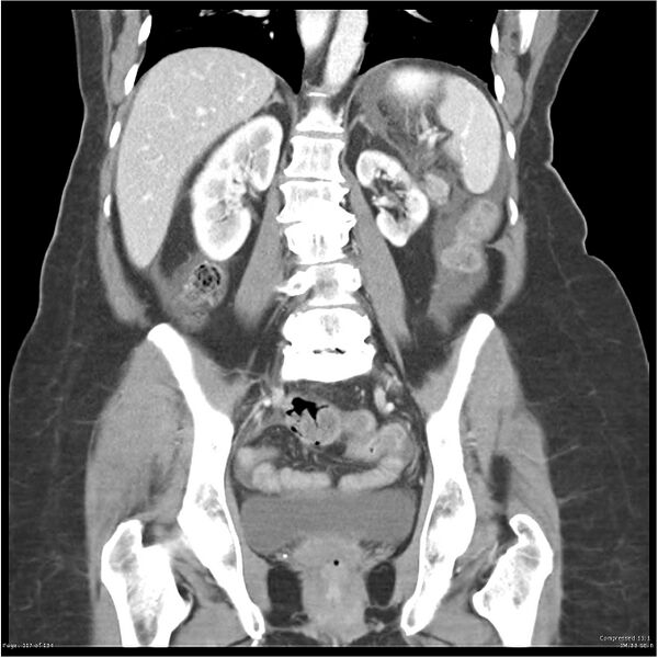 File:Acute pancreatitis (Radiopaedia 19136-19117 Coronal C+ portal venous phase 27).jpg