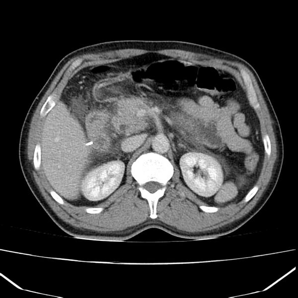 File:Acute pancreatitis (Radiopaedia 22572-22596 Axial C+ portal venous phase 25).jpg