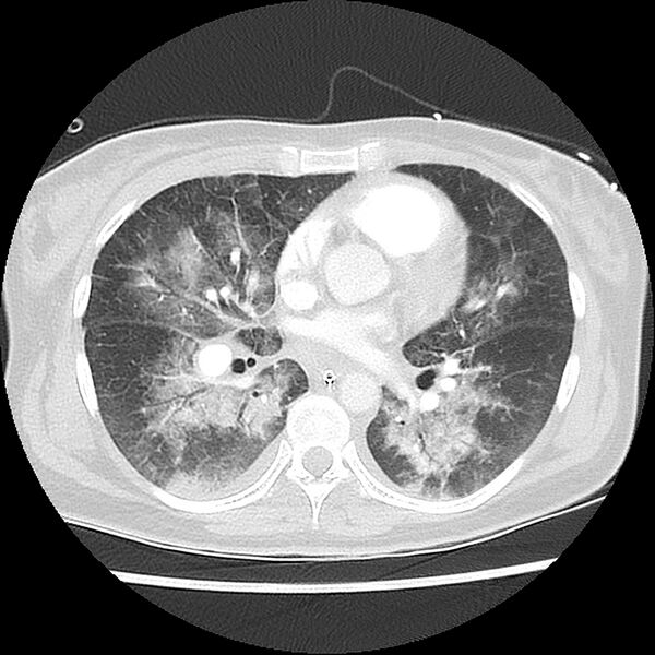 File:Acute pulmonary edema on CT (Radiopaedia 33582-34672 Axial lung window 29).jpg
