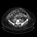Acute pyelonephritis (Radiopaedia 25657-25837 Axial renal parenchymal phase 55).jpg
