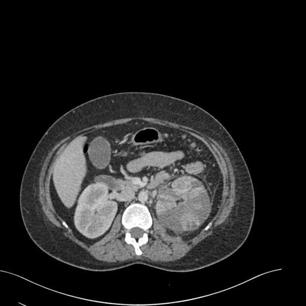 File:Acute pyelonephritis with renal vein thrombosis (Radiopaedia 58020-65053 Axial renal parenchymal phase 57).jpg