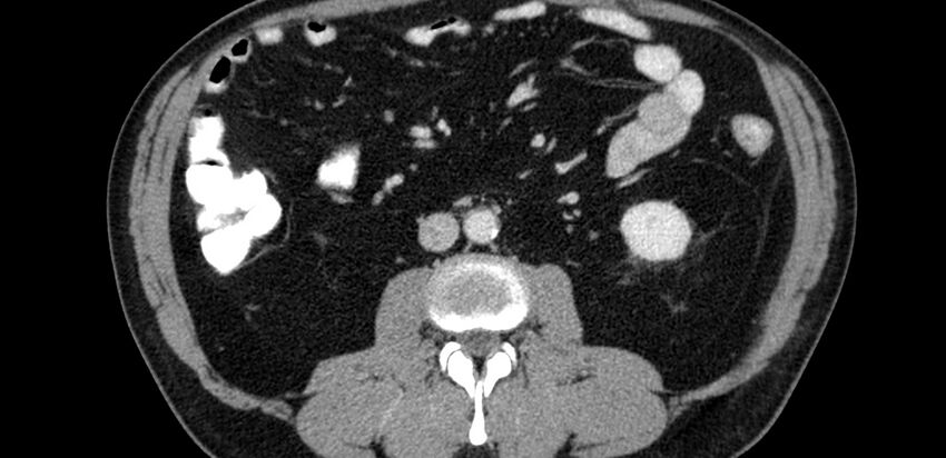 Acute sigmoid colon diverticulitis (Radiopaedia 55507-61976 Axial C+ portal venous phase 16).jpg