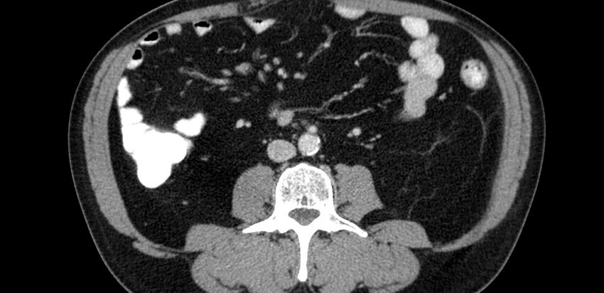 Acute sigmoid colon diverticulitis (Radiopaedia 55507-61976 Axial C+ portal venous phase 26).jpg