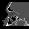 Acute sinusitis (Radiopaedia 23161-23215 Sagittal bone window 25).jpg