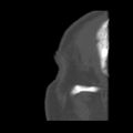Acute sinusitis (Radiopaedia 23161-23215 Sagittal bone window 3).jpg