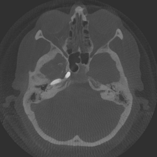File:Acute subarachnoid hemorrhage and accessory anterior cerebral artery (Radiopaedia 69231-79010 Axial arterial - MIP 17).jpg