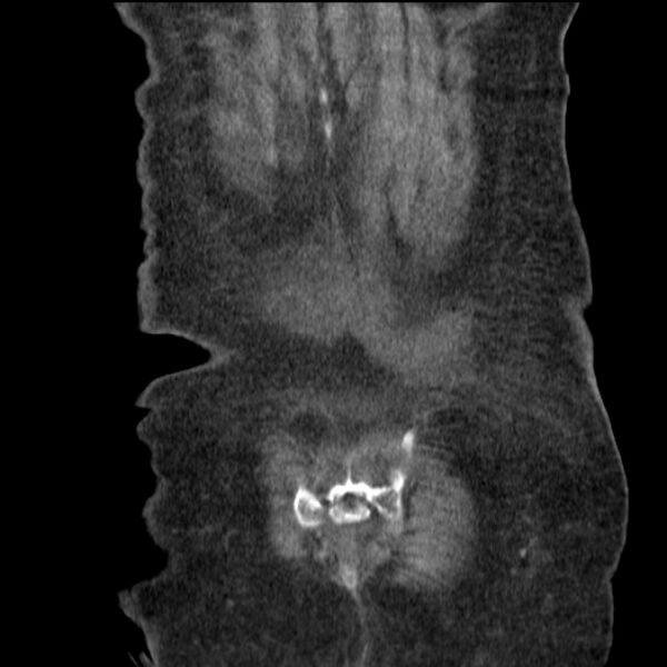 File:Acute tubular necrosis (Radiopaedia 28077-28334 G 76).jpg