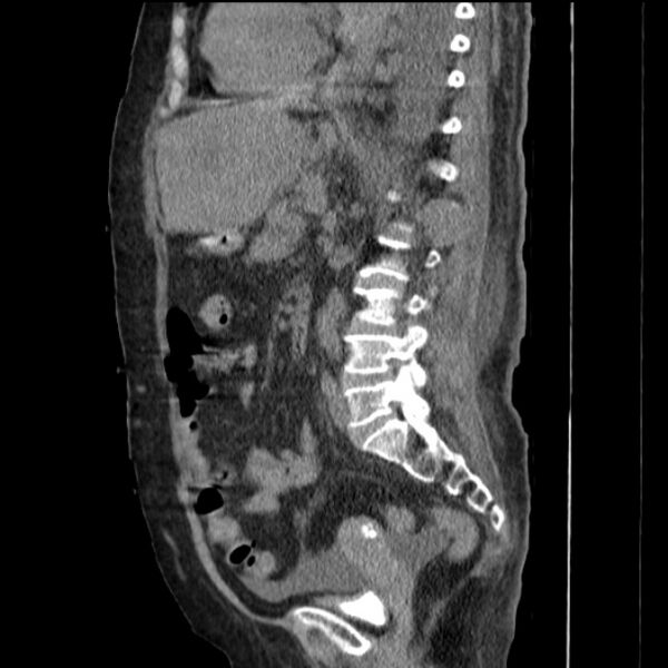 File:Acute tubular necrosis (Radiopaedia 28077-28334 H 52).jpg