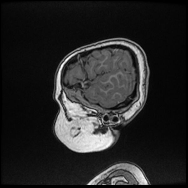 File:Adamantinomatous craniopharyngioma (Radiopaedia 77407-89529 Sagittal T1 C+ 14).jpg