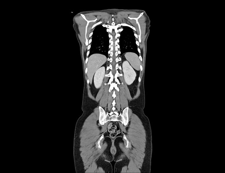 File:Addison disease (Radiopaedia 49318-54412 Coronal C+ portal venous phase 8).jpg