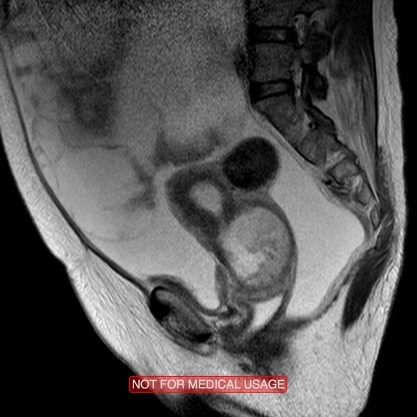 File:Adenocarcinoma of the cervix (Radiopaedia 28373-28615 Sagittal T2 10).jpg