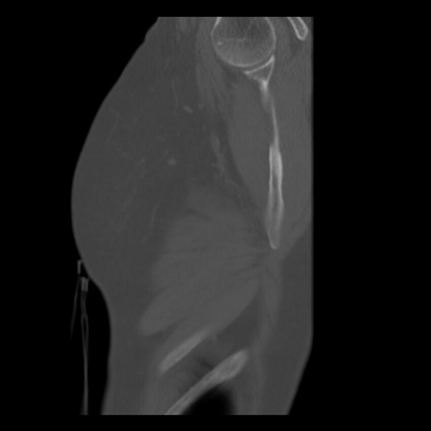 Adenocarcinoma of the lung (Radiopaedia 41015-43755 Sagittal bone window 107).jpg