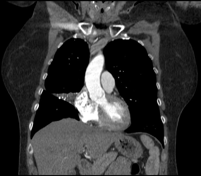 File:Adenocarcinoma of the lung (Radiopaedia 44205-47803 Coronal C+ portal venous phase 29).jpg