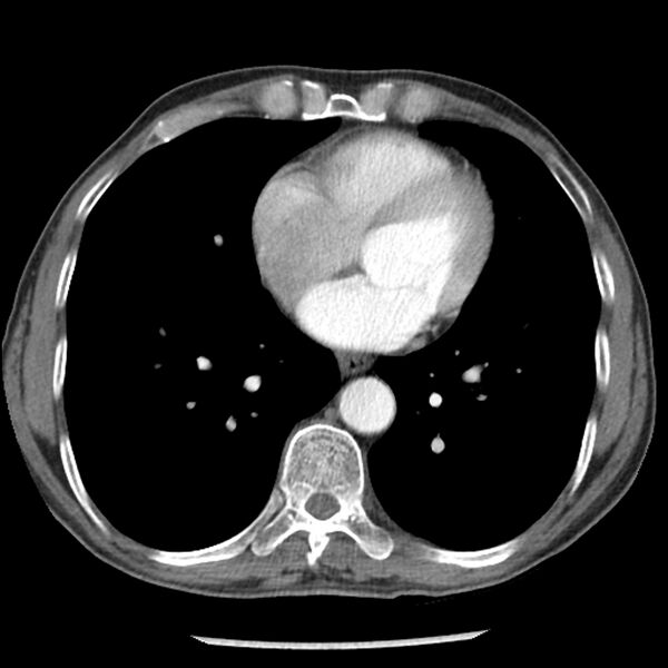 File:Adenocarcinoma of the lung - micropapillary predominant (Radiopaedia 42446-45563 Axial C+ portal venous phase 49).jpg