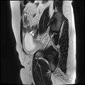 Adenomyosis - ovarian endometriomas (Radiopaedia 67031-76350 Sagittal T2 3).jpg