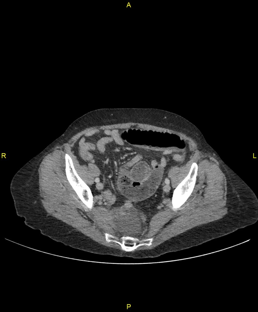 Adhesional small bowel obstruction (Radiopaedia 85402-101024 Axial C+ portal venous phase 232).jpg