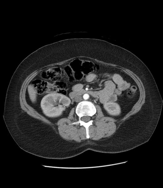File:Adrenal cortical carcinoma with IVC invasion and thrombosis (Radiopaedia 34307-35597 Axial C+ arterial phase 43).jpg