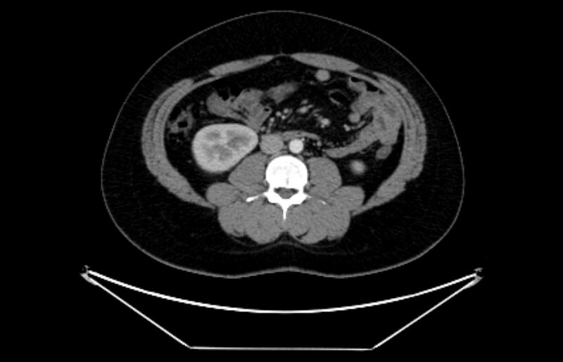 File:Adrenocortical carcinoma (Radiopaedia 80134-93438 Axial C+ portal venous phase 69).jpg