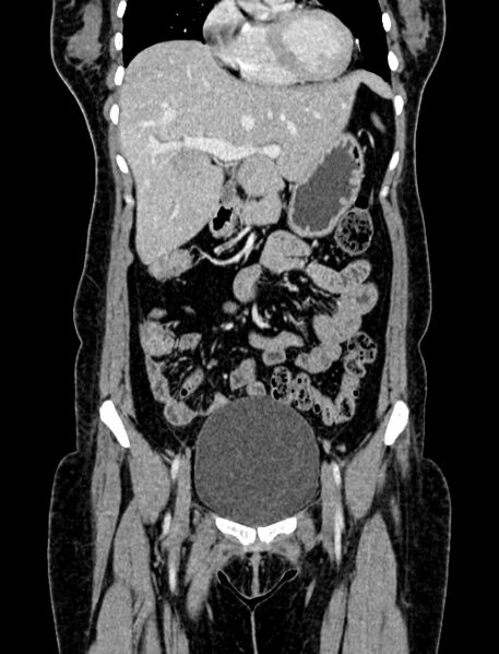 File:Adrenocortical carcinoma (Radiopaedia 87281-103569 Coronal C+ portal venous phase 1).jpg