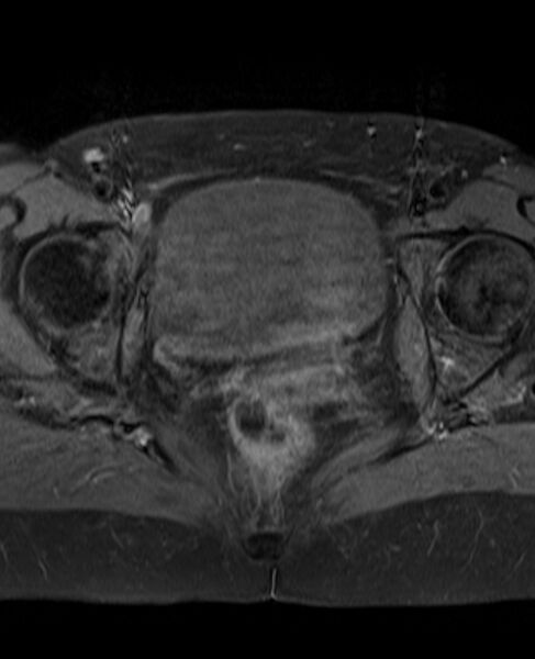 File:Adult granulosa cell tumor of the ovary (Radiopaedia 71581-81950 Axial T1 C+ fat sat 20).jpg