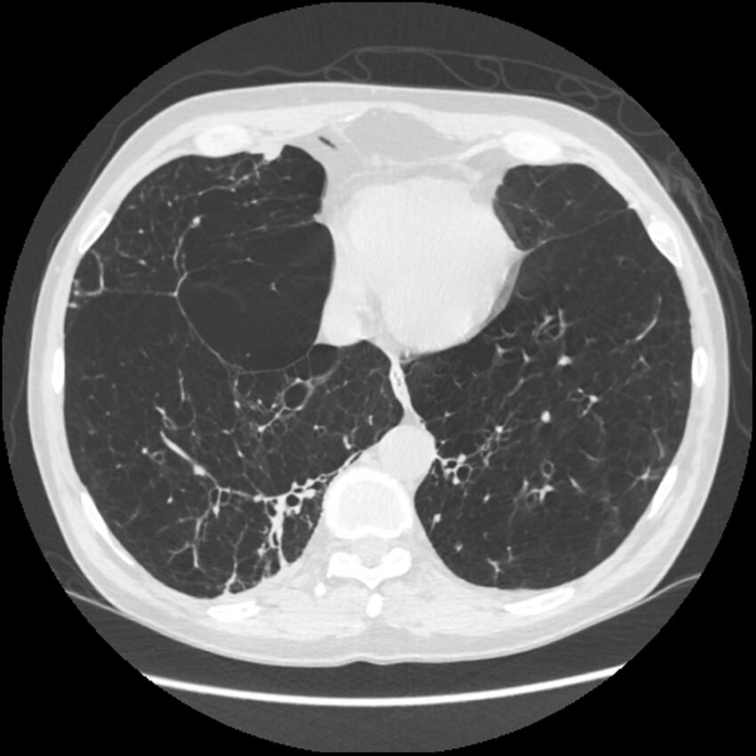 Alpha-1-antitrypsin deficiency (Radiopaedia 40993-43722 Axial lung window 182).jpg