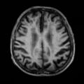 Alzheimer disease (Radiopaedia 10738-11199 Axial T1 14).jpg
