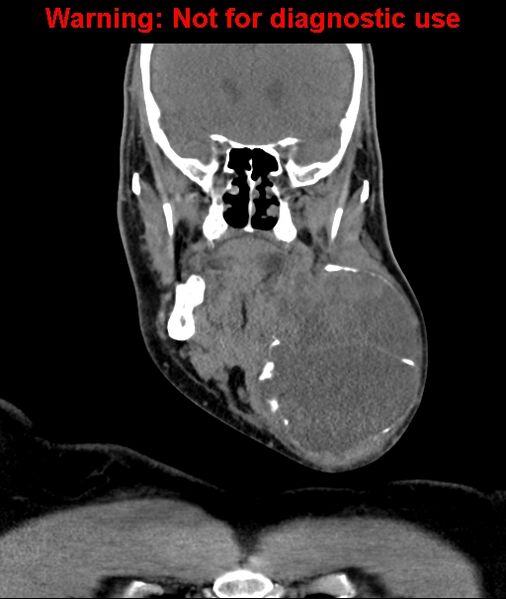 File:Ameloblastoma (Radiopaedia 33126-34164 D 30).jpg