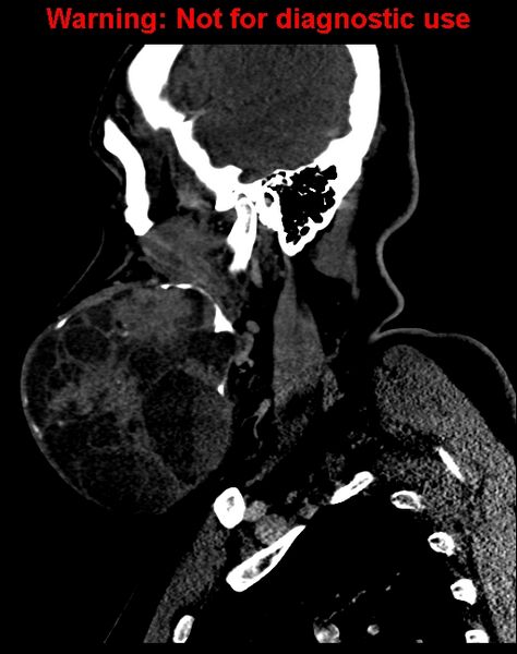 File:Ameloblastoma (Radiopaedia 33126-34164 F 18).jpg
