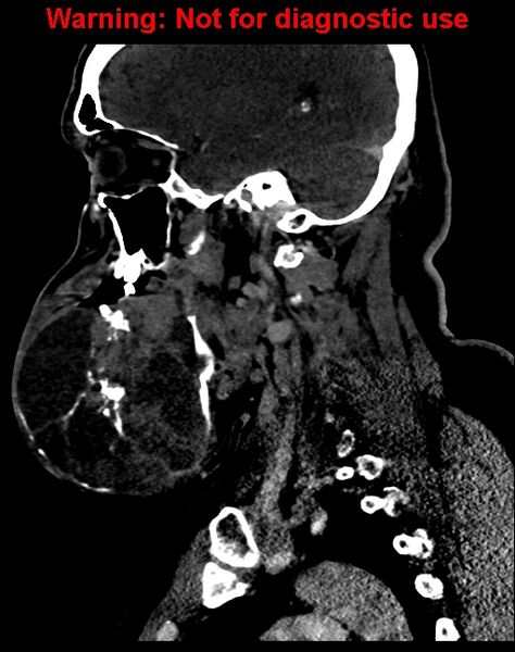 File:Ameloblastoma (Radiopaedia 33126-34164 F 27).jpg