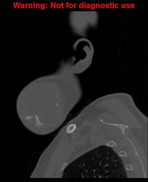 File:Ameloblastoma (Radiopaedia 33126-34164 Sagittal bone window 12).jpg