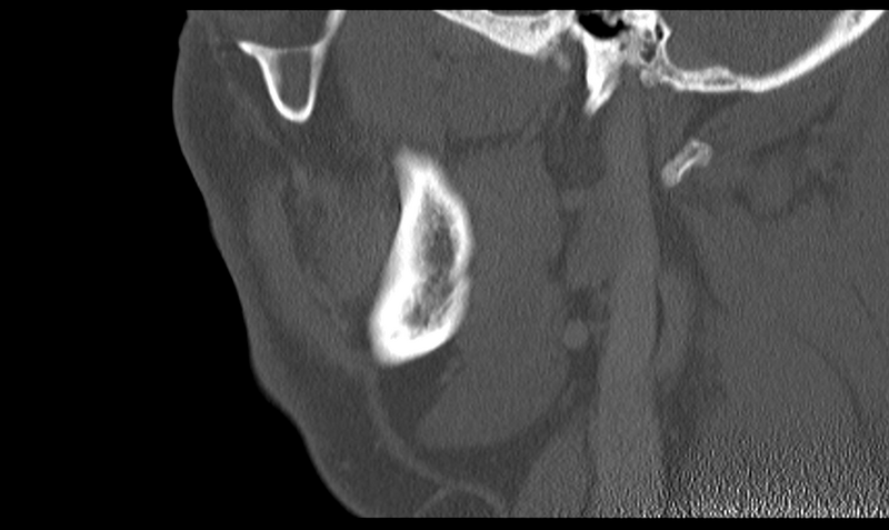 File:Ameloblastoma (Radiopaedia 33677-34806 Sagittal bone window 46).png