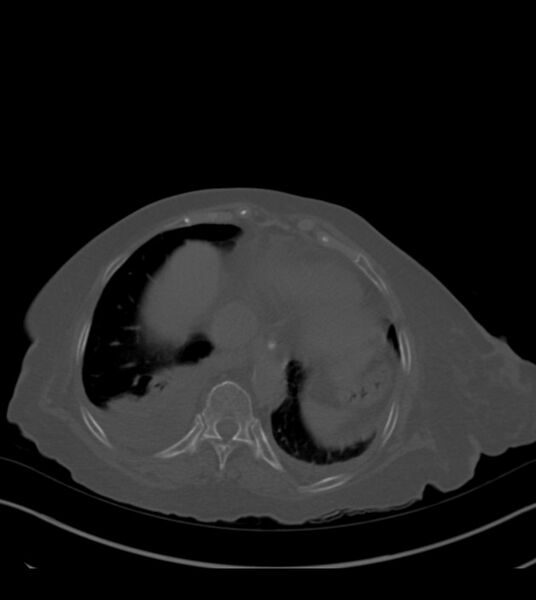 File:Amiodarone deposition in the liver (Radiopaedia 77587-89780 Axial bone window 65).jpg