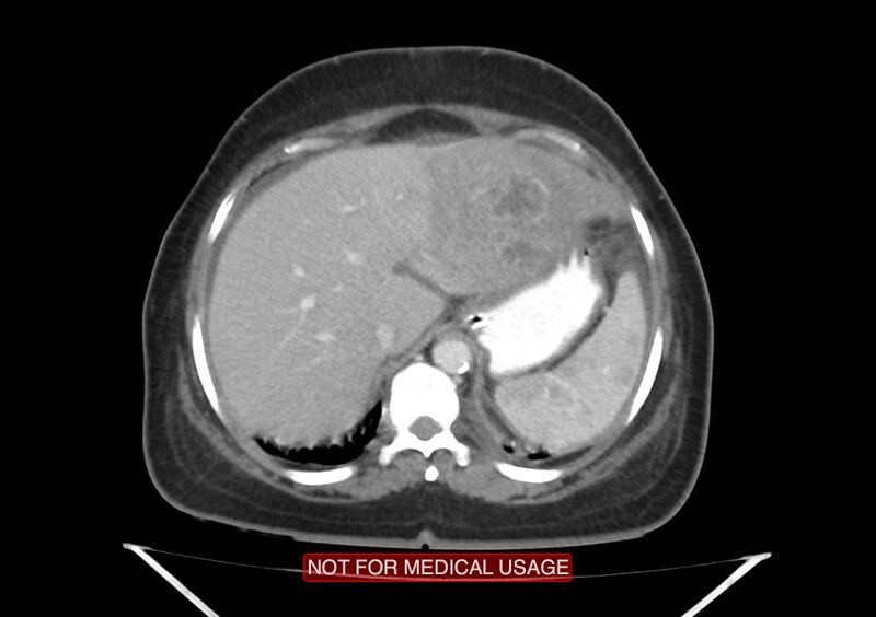 File:Amoebic enterocolitis with liver abscess (Radiopaedia 35100-36609 A 17).jpg
