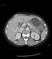 Ampulla of Vater metastasis (Radiopaedia 27820-28069 A 13).jpg