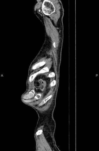 File:Ampullary adenocarcinoma (Radiopaedia 86093-102033 E 92).jpg