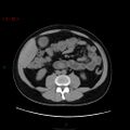 Ampullary carcinoma (Radiopaedia 56396-63056 Axial non-contrast 28).jpg