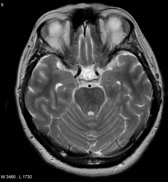 File:Amyotrophic lateral sclerosis (Radiopaedia 5373-7134 Axial T2 9).jpg