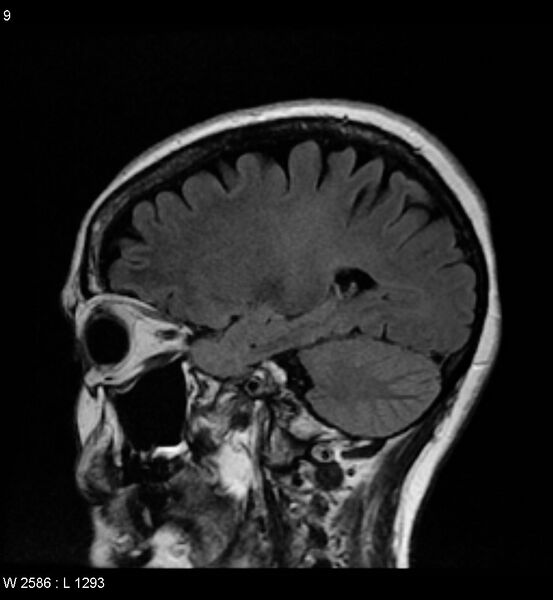 File:Amyotrophic lateral sclerosis (Radiopaedia 5373-7134 Sagittal FLAIR 5).jpg