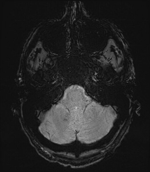 File:Amyotrophic lateral sclerosis (Radiopaedia 87352-103658 Axial SWI 4).jpg