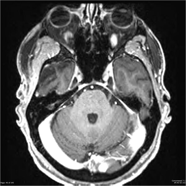 File:Anaplastic meningioma with recurrence (Radiopaedia 34452-35788 Axial T1 C+ 40).jpg