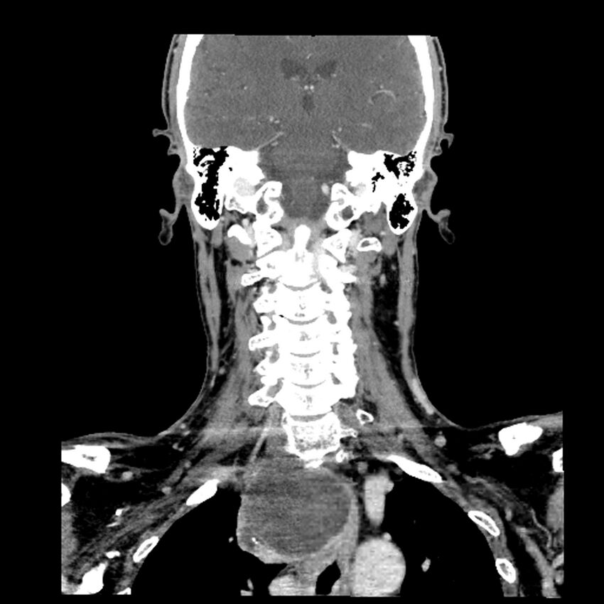 Anaplastic thyroid carcinoma (Radiopaedia 79087-92034 A 76).jpg